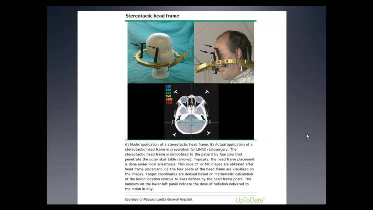 Stereotactic Radiosurgery Margaret Menendez, MD 9/16/16 YouTube