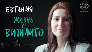 Евгения. Жизнь с витилиго. Интервью для вМесте