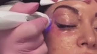 Skin Tightening