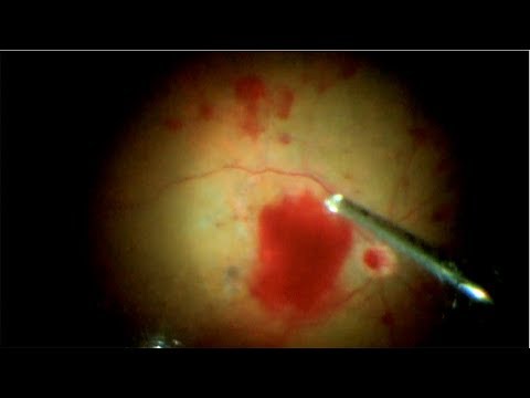 Vídeo: El Efecto Del Conberceptio Intravítreo Adyuvante Al Final De La Vitrectomía Diabética Para La Prevención De La Hemorragia Post-vitrectomía En Pacientes Con Retinopatía Diabética Pr