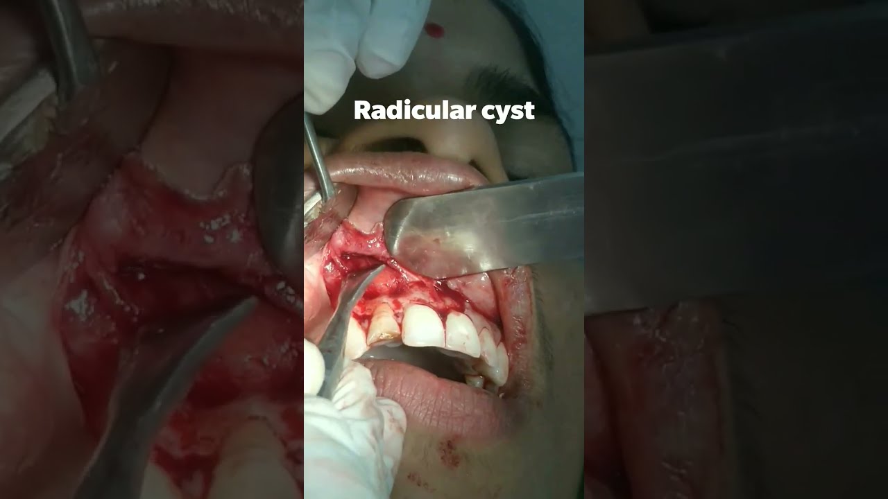  Radicular Cyst Dentistry