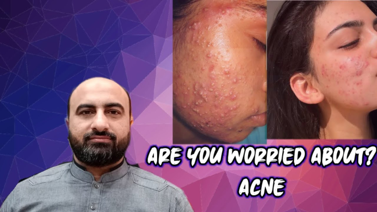 Are you worried about?Acni