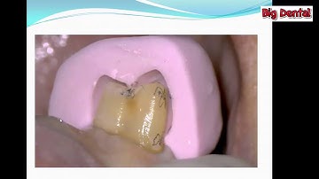 Hướng dẫn mài cùi răng cối nhỏ hàm dưới