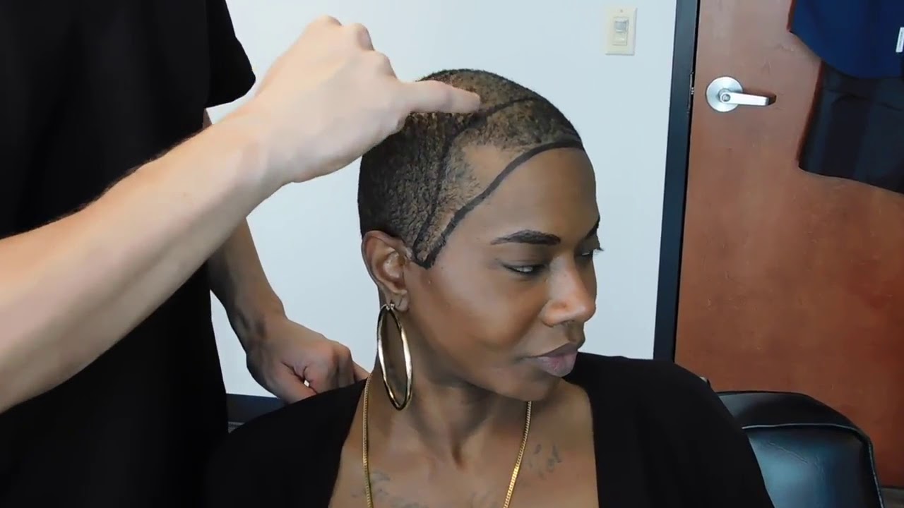 Transgender Hair Transplant  |  Hairline Surgery from Natural Transplants