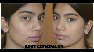best drugstore concealer to cover acne