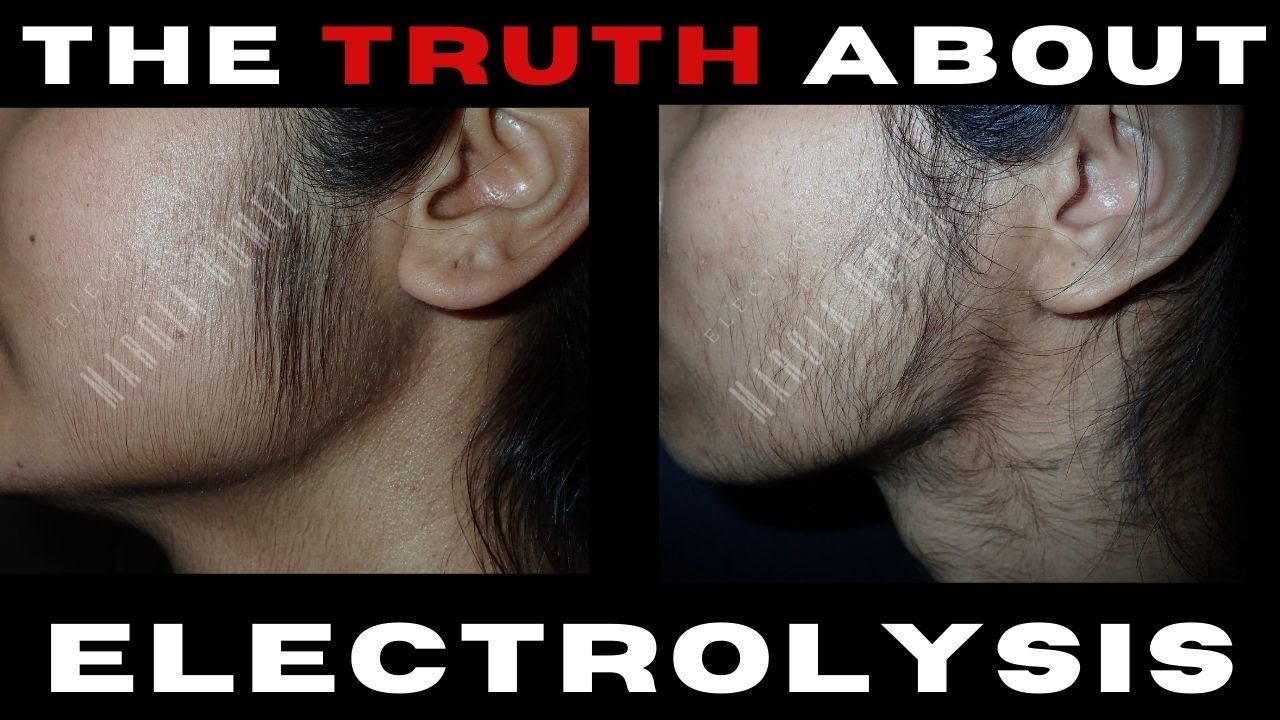 ELECTROLYSIS HAIR REMOVAL (PCOS) YouTube