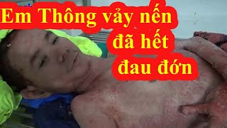 Em Thông bị vả,,y n;ến nặng nhất Việt Nam đã thôi không còn đau đớn/KPMT