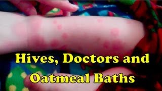 oatmeal bath for hives