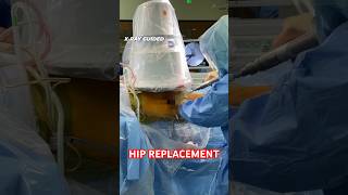 Robotic vs C-arm Hip Replacement 🤖 #shorts