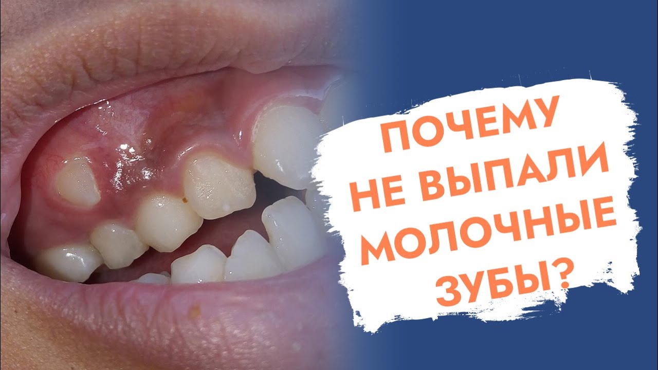 Молочные зубы. Почему не выпали у взрослого?