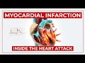 Myocardial Infarction الجلطة القلبية أول دقيقة قد تنقذ الحياة 