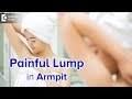 Painful armpit lump  causes diagnosis and treatment  dr nanda rajaneesh  doctors circle