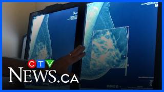 StatsCan report finds 'meaningful differences’ in breast cancer outcomes across Canada