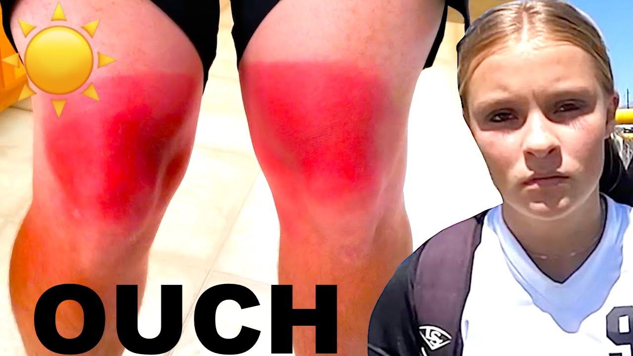 2ND DEGREE SUNBURN on LEGS at SOFTBALL TOURNAMENT! ☀️🔥