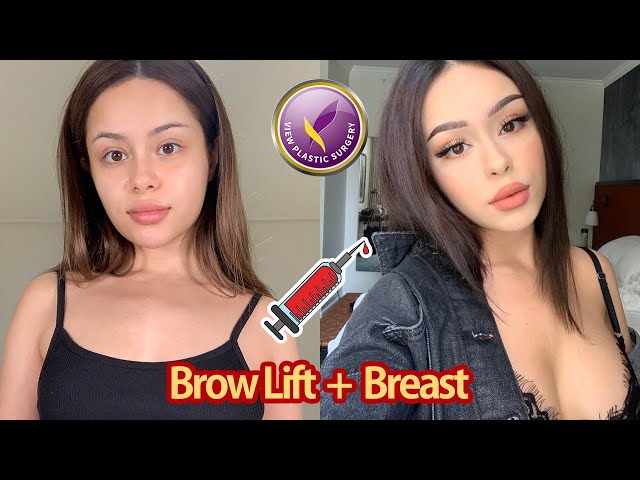 【View Plastic Surgery】 Endotine Brow Lift + Motiva Breast Implant
