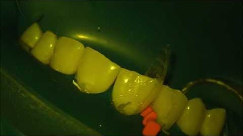 injection molding with bioclear matrix