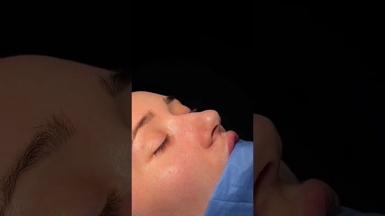 Ринопластика в Кишинёве 