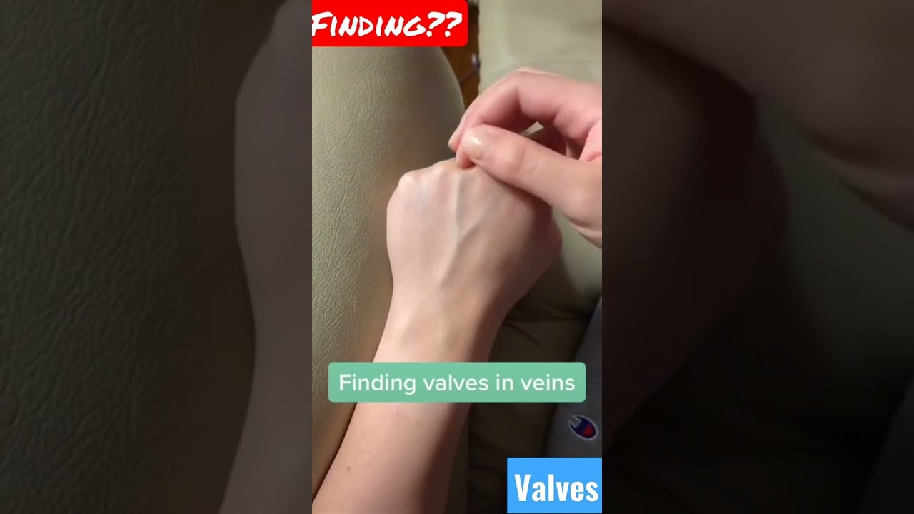 Finding Valves in the Vein ??