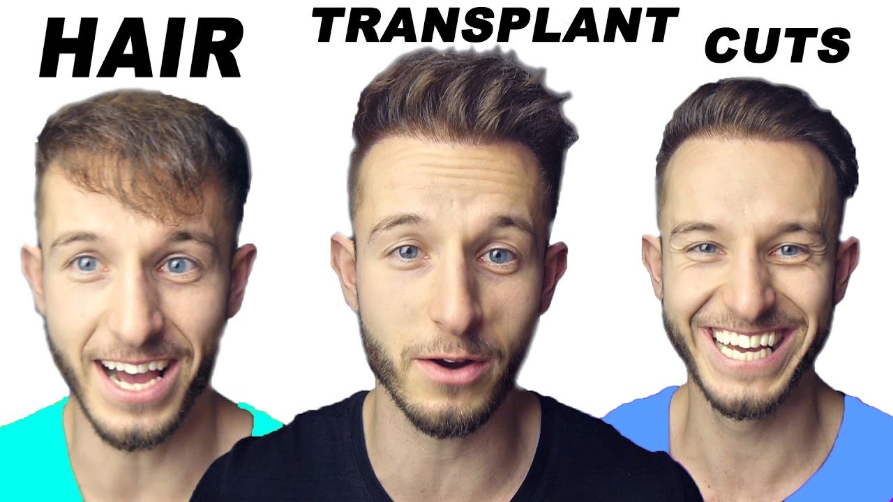 My 3 Favorite Hairstyles After My Hair Transplant! - YouTube