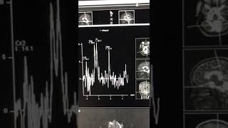 Pilocytic astrocytoma with drop metastasis