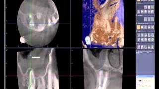Famous How to read a CBCT (Cone Beam Computed Tomography) Scan Net Worth