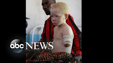 What percentage of Africans are albino?