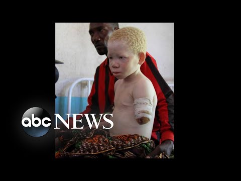 Tanzanian children lost limbs in brutal attacks for having albinism Part 1 