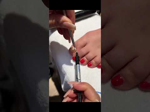 مراحل تخلیه ناخن فرورفته در گوشت و نصب ارتونیل پدیکور پودولوژی   