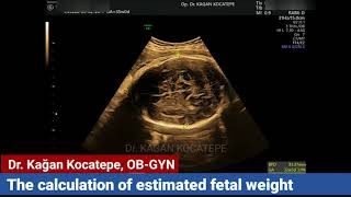 How is the fetal weight of your baby calculated with ultrasound, which measurements are necessary?