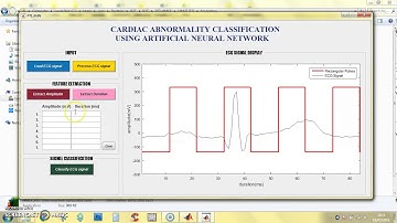 ECG Features Extraction (Amplitude & Duration)