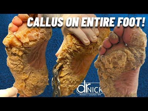 SHAVING CALLUS ON ENTIRE SOLE OF FOOT!!! Dr. Nick Campitelli, Foot & Ankle Surgeon