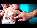 HEMANGIOMAS & BABIES... (What Parents Need to Know) | Dr. Paul “Retired”