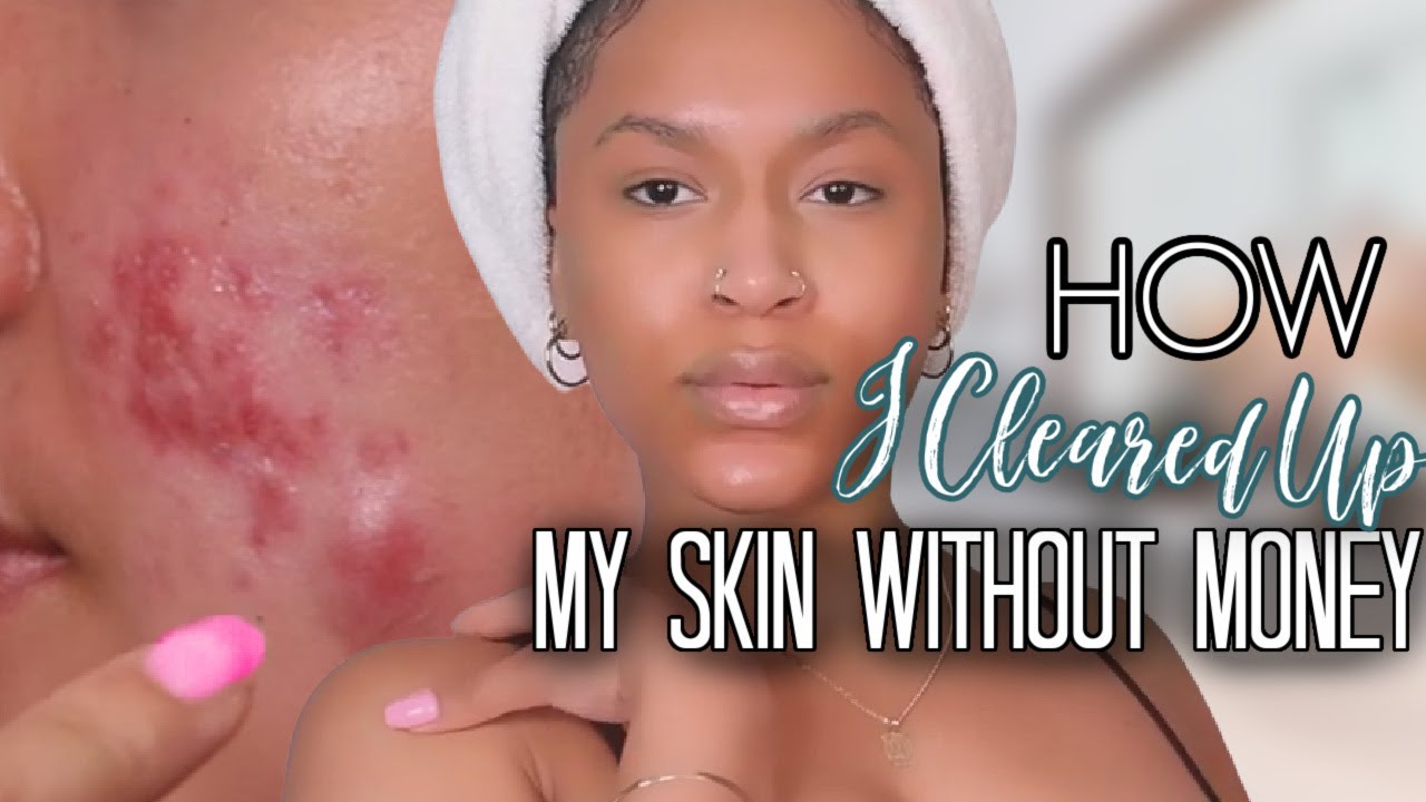 HOW I CLEARED UP MY SKIN WITHOUT SPENDING MONEY - YouTube