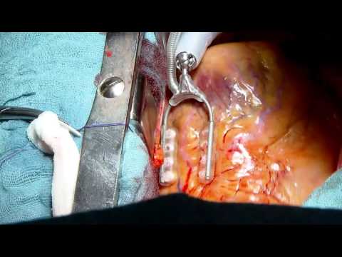 Video: Verschil Tussen Bypass En Openhartchirurgie