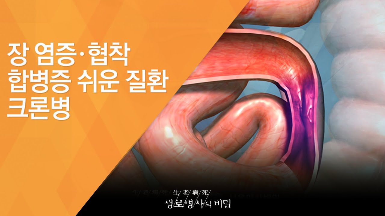 장 염증·협착 합병증 쉬운 질환, 크론병 - (20140409_499회 방송)_내 몸 안의 반란, 염증성 장질환 - YouTube