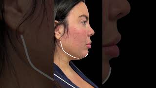 NeckLiposuction / FaceTite / Morpheus8 ( case by Dr. Tebyanian )