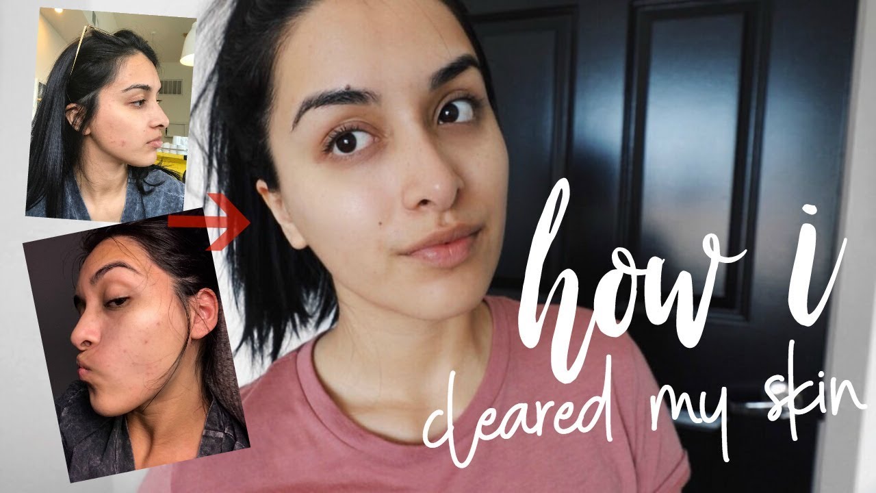 HOW I CLEARED UP MY SKIN + BANISHED BREAKOUTS - YouTube