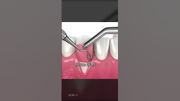 Soft Tissue Graft Surgery for Receding Gums