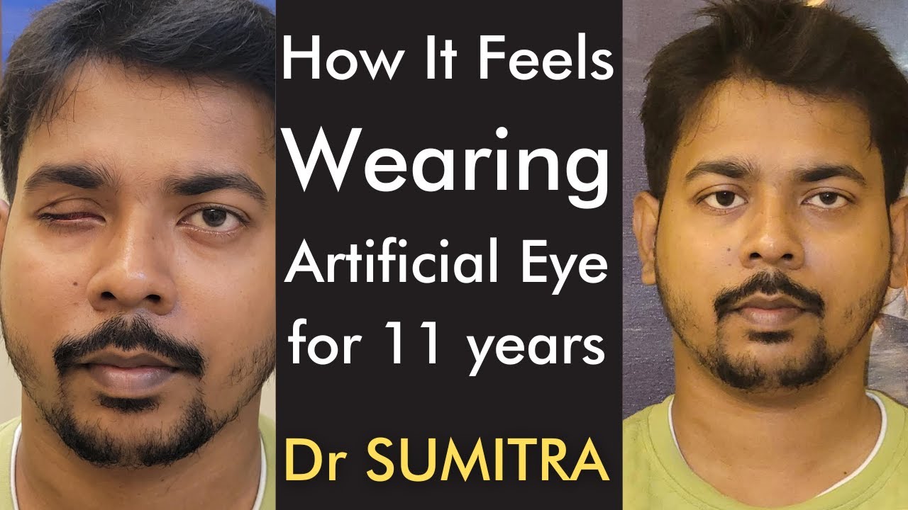 What I Learnt in 11 Years With ARTIFICIAL EYE | My experience with with prosthetic eye