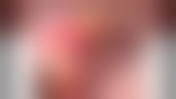 Trigeminal Neuralgia Surgery: Endoscopic decompression of Trigeminal nerve