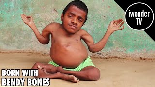 The Indian Man That Was Born With Bendy Bones