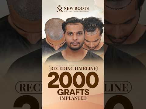 Receding Hairline Surgery | Cost and Best Results | Hair Transplant in Pune #hairline #shorts