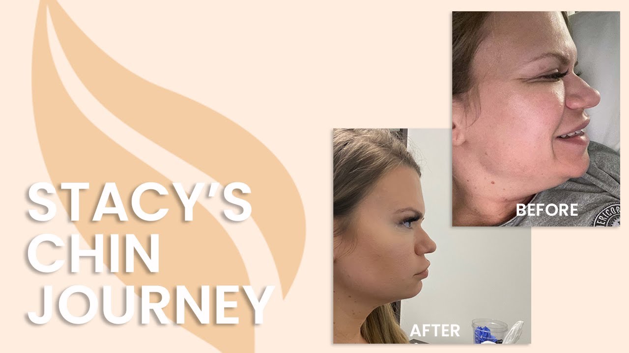 Sono Bello Laser Liposuction Ditch Your Chin Fat In 1 Day Youtube