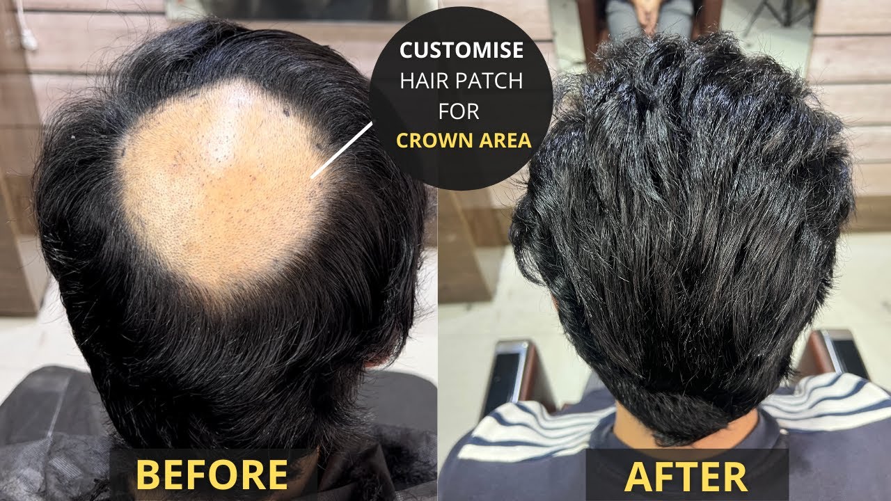 Customise Hair Patch For Crown Area | Non Surgical Hair Replacement In 2  Hour | Hair Wig House - YouTube