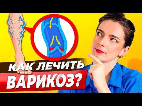 Видео: ВЕНЫ НА НОГАХ || Как убрать, чем лечить? Массаж, спорт, лекарства, народные средства при варикозе