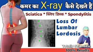 कमर क एकस र कस दख Loss Of Lumbar Lordosis Kya Hota Hai Hindi कमर दरद कय हत ह