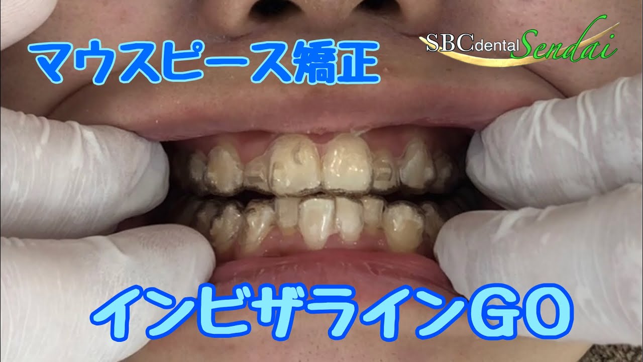 アタッチメント編・マウスピース矯正（インビザラインＧＯ）