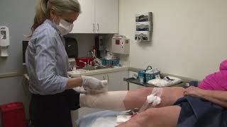 Sclerotherapy procedure for spider veins.