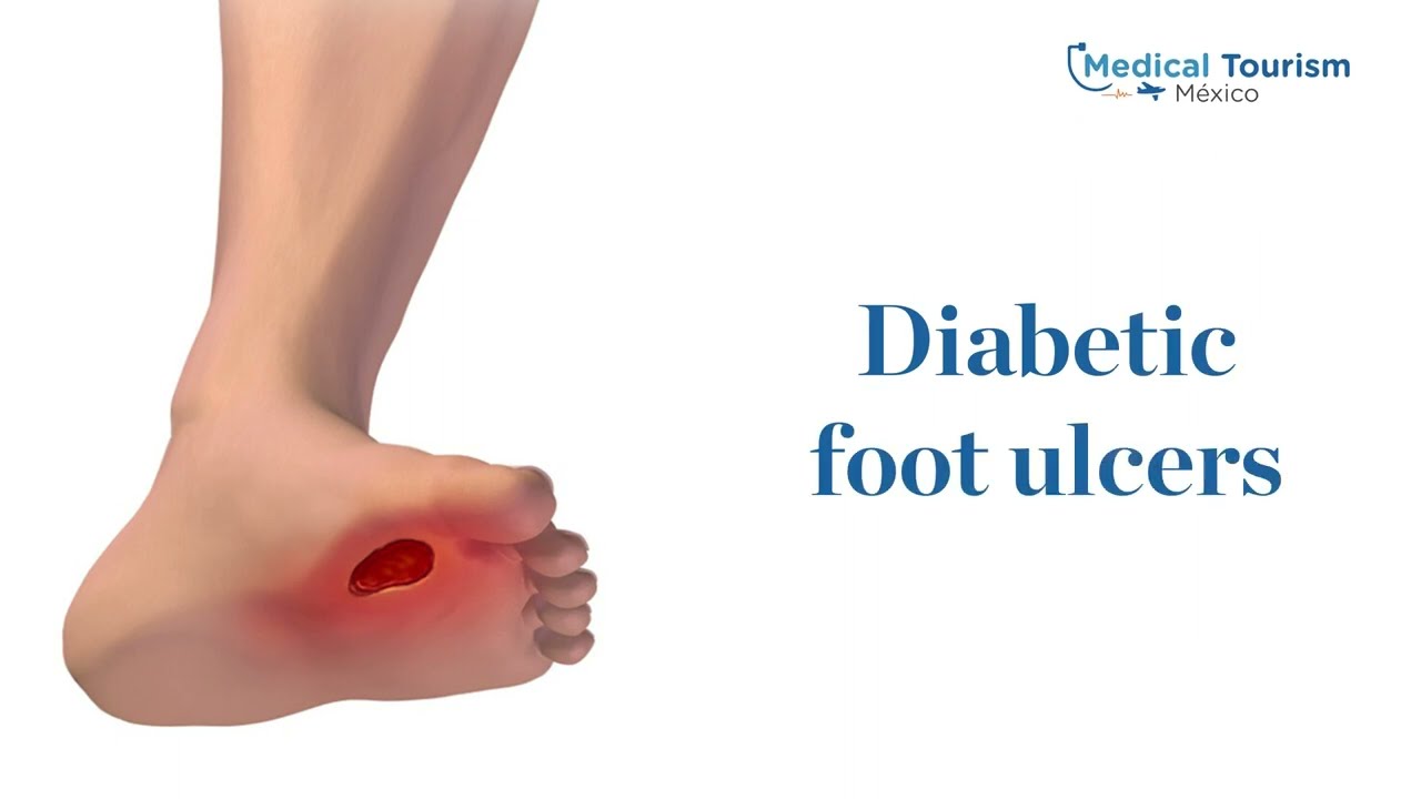 Diabetic Foot Ulcer Doctor's Clinic GA - Prevention & Care - Georgia  Infectious Diseases Specialist | Wound Care Center