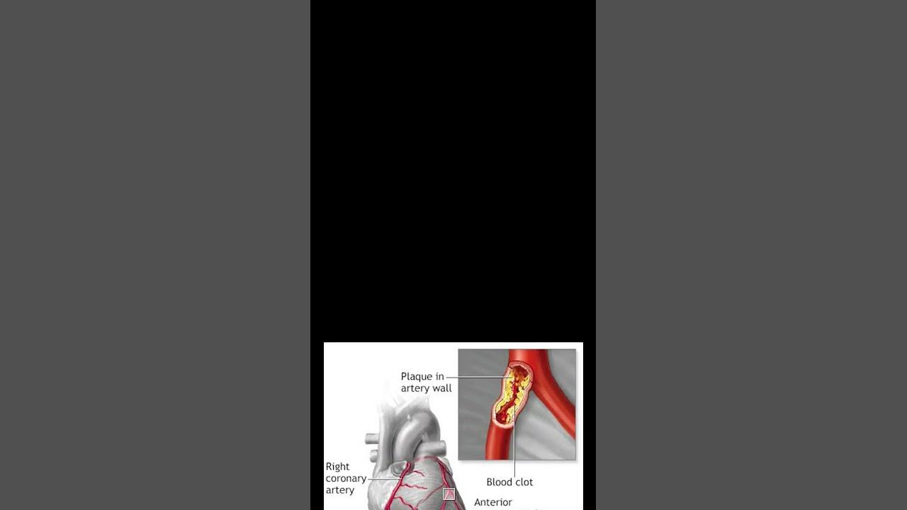 heart bypass surgery (CABG) YouTube